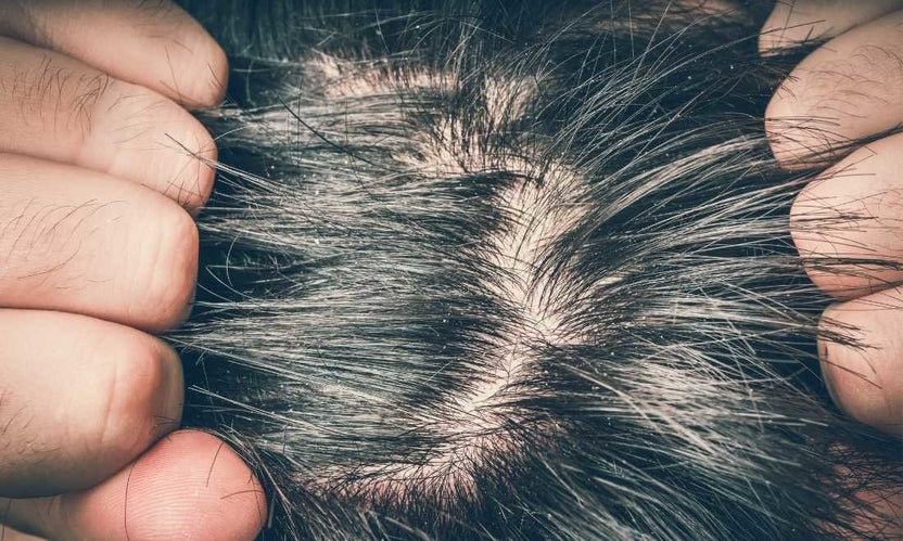 Wat te doen bij roos en schilfers op de hoofdhuid – The Alpha Men