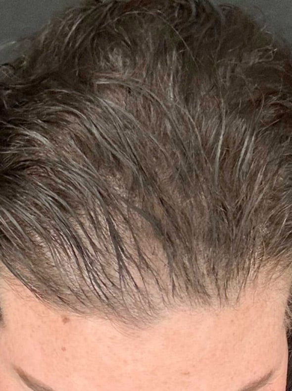 Calecim Advanced Hair System Kit